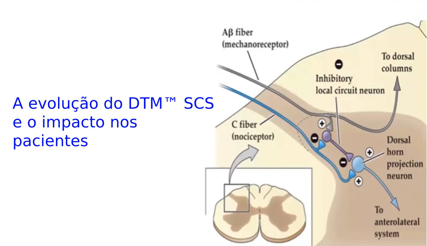 A evolução do DTM™ SCS e o impacto nos pacientes