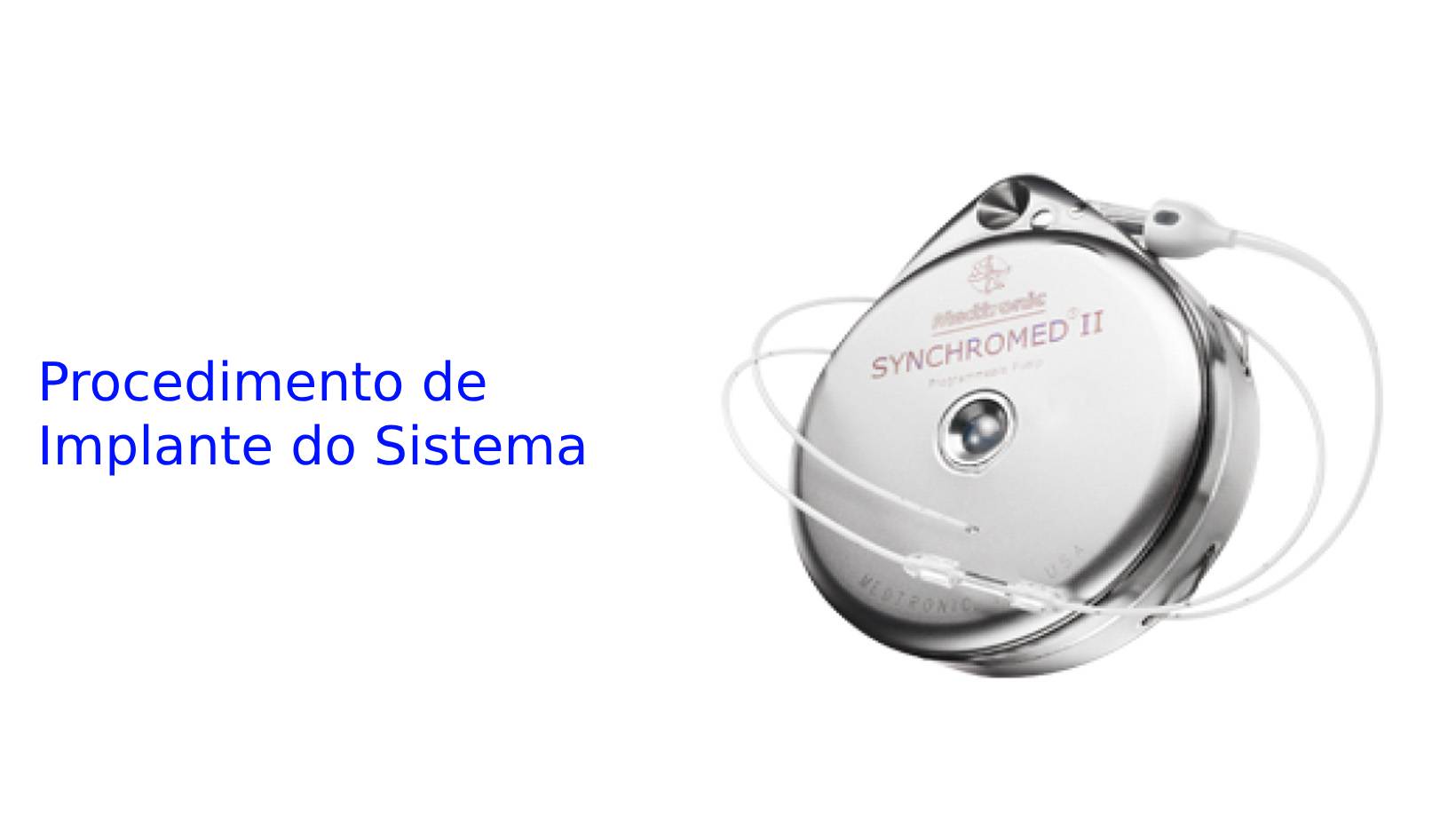 Procedimento de Implante do Sistema.