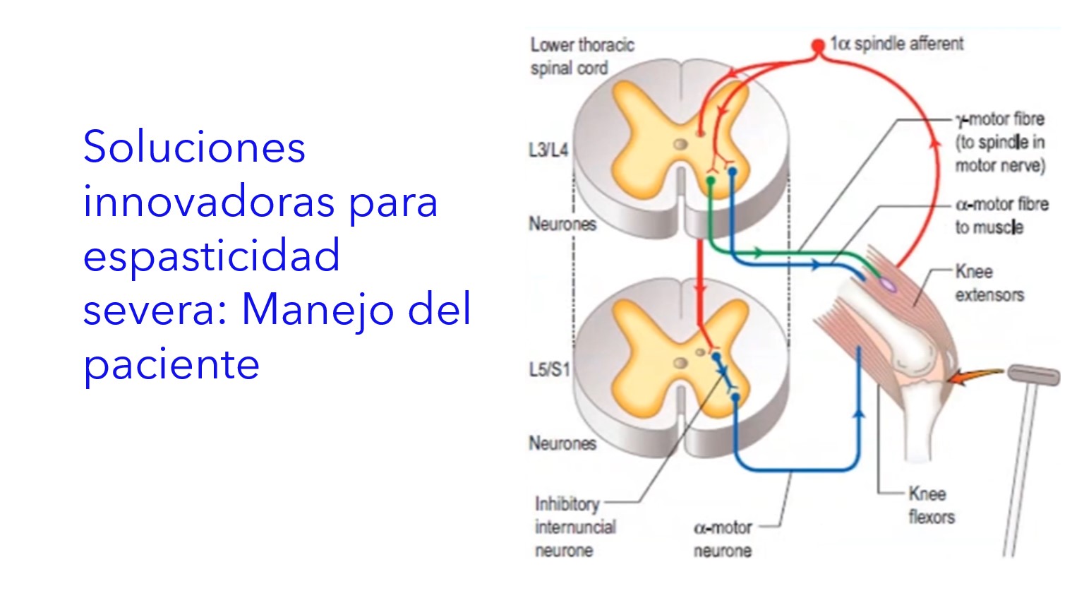 Soluções Inovadoras para Espasticidade Severa: Manejo do Paciente