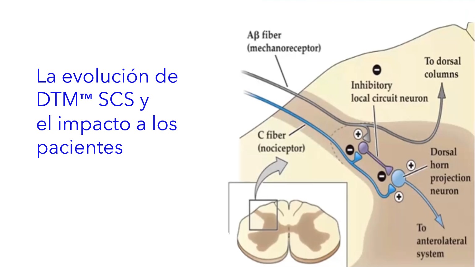 La evolución de DTM™ SCS y el impacto a los pacientes.| A evolução do DTM™ SCS e o impacto nos pacientes.|The evolution of DTM™ SCS and the impact on patients.