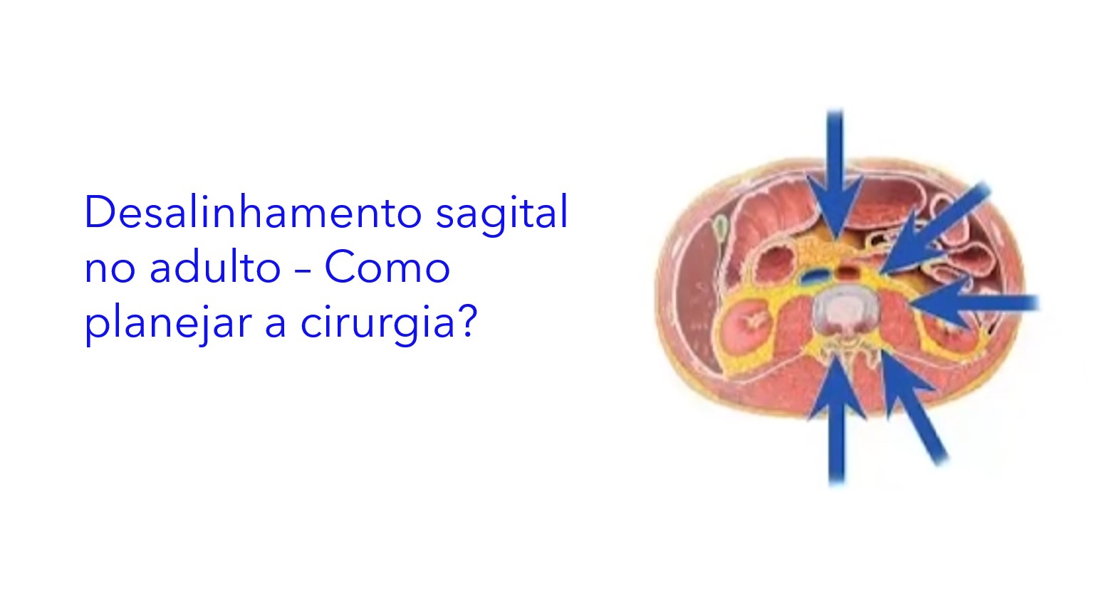 Desalinhamento sagital no adulto – Como planejar a cirurgia?.|Desalineación sagital en adultos – ¿Cómo planificar la cirugía?.|Sagittal misalignment in adults – How to plan surgery?