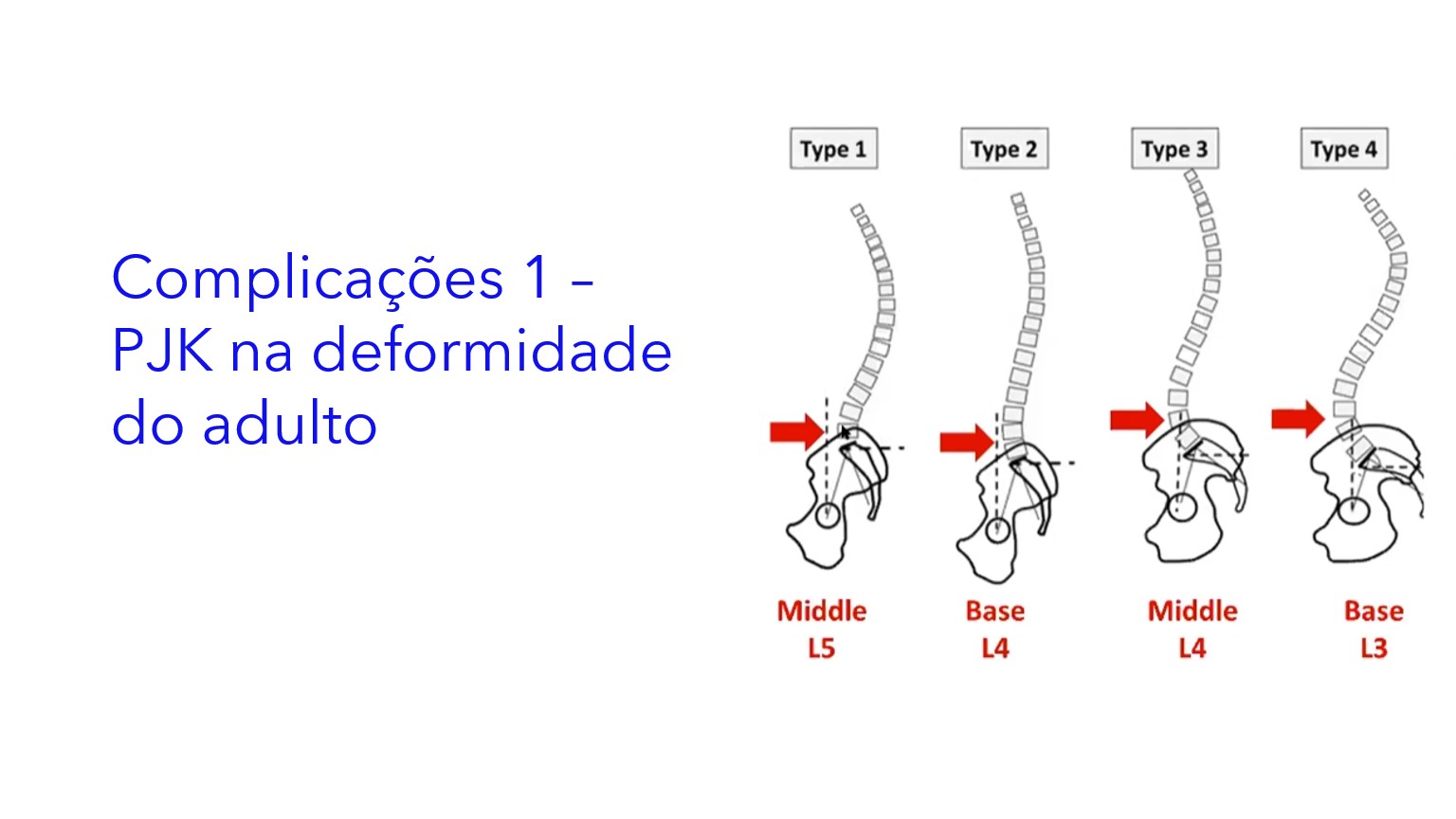 Complicações 1 – PJK na deformidade do adulto|Complicaciones 1 – PJK en la deformidad del adulto|Complications 1 – PJK in adult deformity