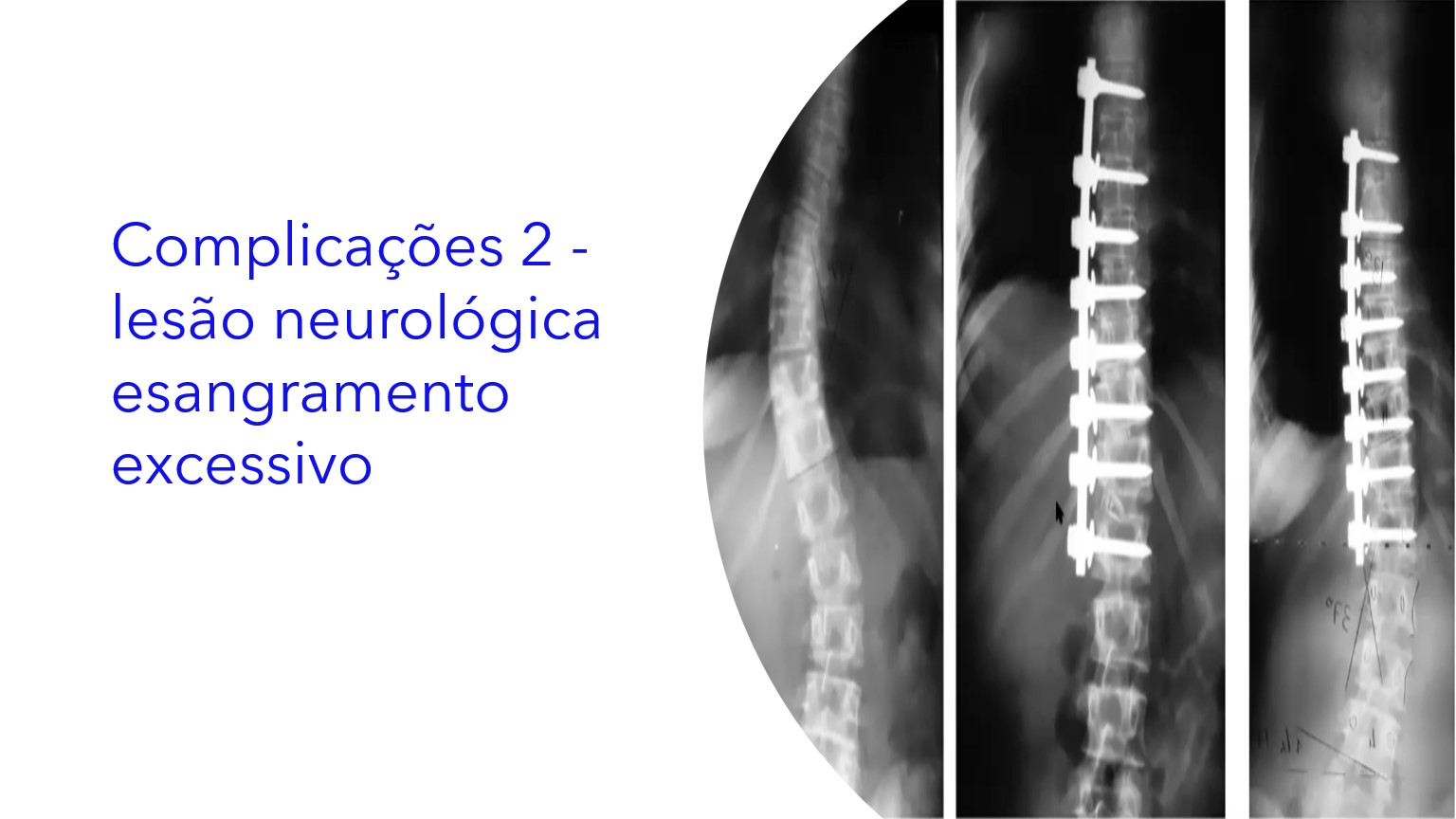 Complicações 2 - Lesão Neurológica e Sangramento Excessivo|Complicaciones 2: lesión neurológica y sangrado excesivo|Complications 2 - Neurological Injury and Excessive Bleeding