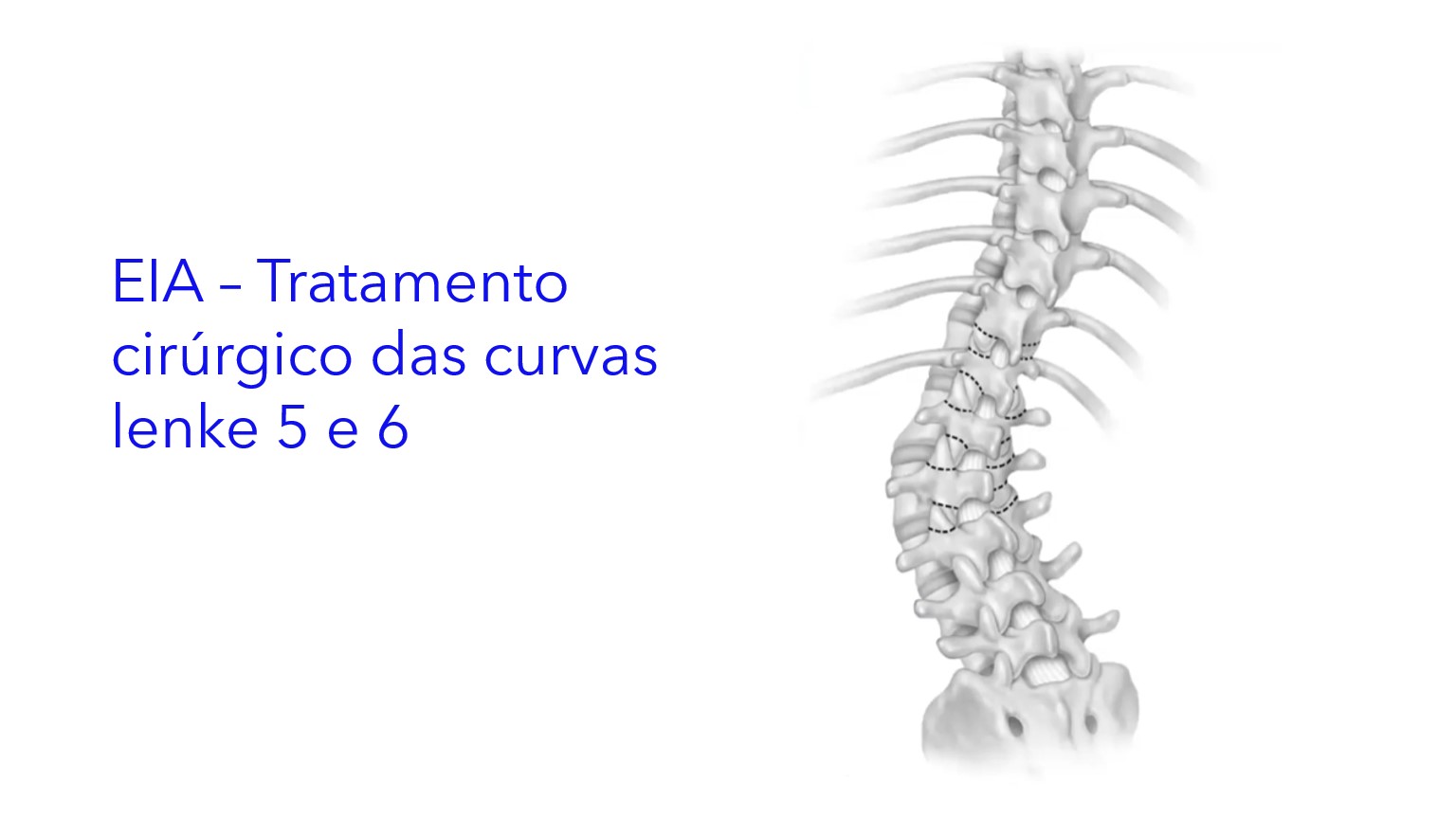 EIA – Tratamento cirúrgico das curvas Lenke 5 e 6